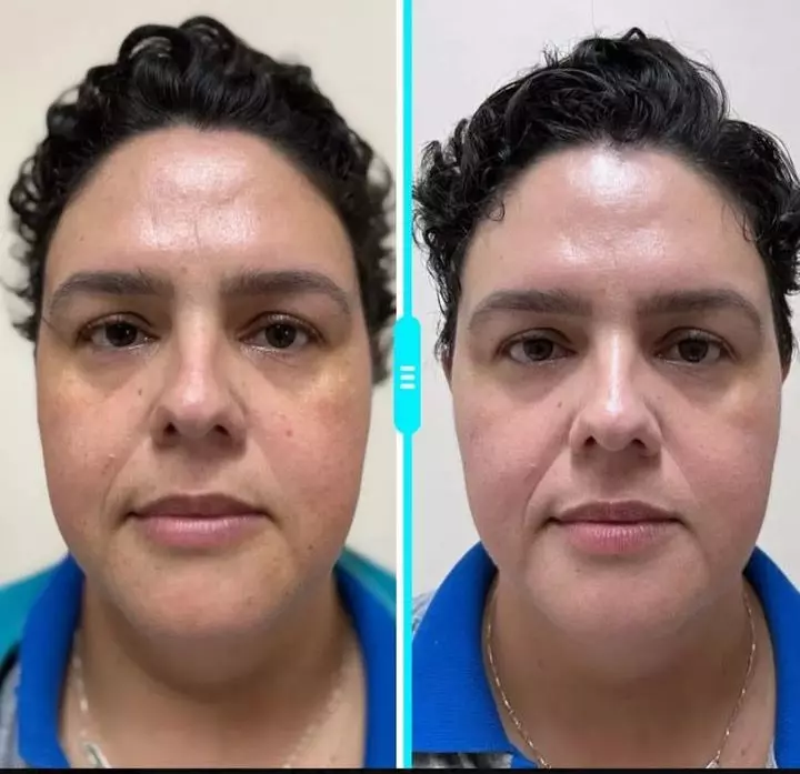Antes-x-Depois-Rosa-Mosqueta-4
